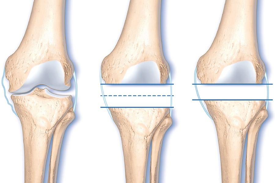 Balance ligamentaire et alignement, quels objectifs prioriser lors de la pose d’une prothèse totale de genou de 1ère intention ?