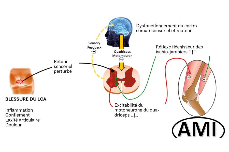 Incidence et facteurs de risque d’AMI (Arthrogenic Muscle Inhibition) après reconstruction du LCA
