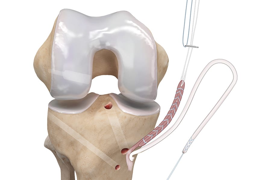 Laisser pédiculés les tendons des ischiojambiers lors d’une reconstruction du LCA par autogreffe