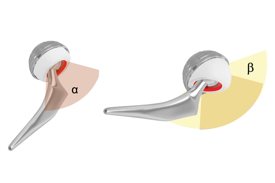 Double mobilité et voie antérieure : est-ce utile ?