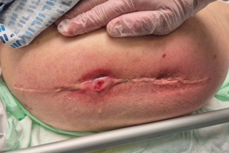Les limites de la conservation des implants en cas d’infection de prothèse ostéo-articulaire