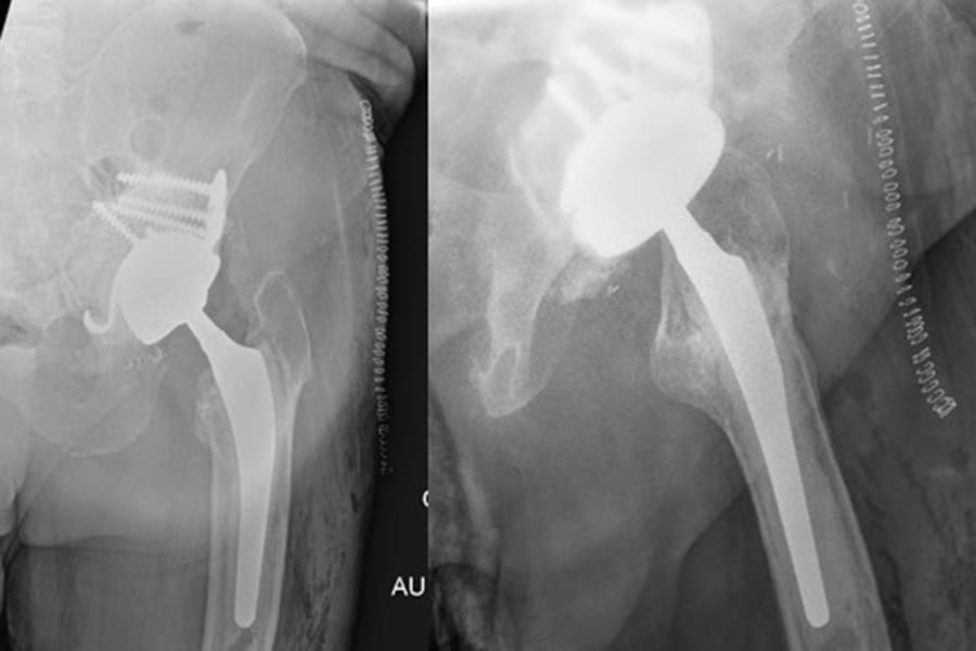 Traitement des infections chroniques de prothèses de hanche et de genou par changement en 1 temps