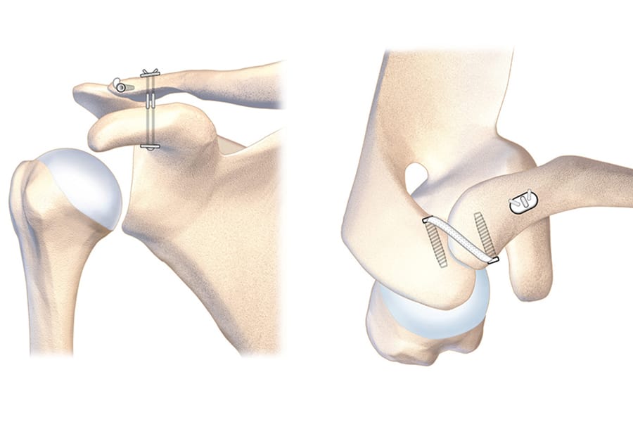 Disjonctions acromio-claviculaires aiguës opérées par double stabilisation acromio-claviculaire et coraco-claviculaire