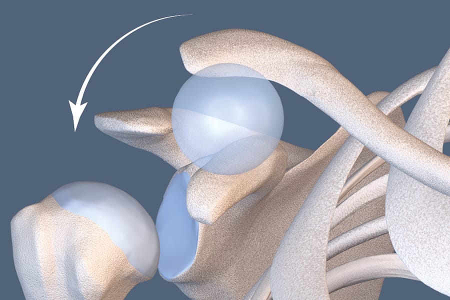 Les disjonctions acromio-claviculaires : 20 ans d'expérience