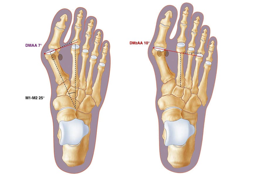Chirurgie mini-invasive et percutanée de l’hallux valgus : qu’avoir abandonné, conservé, modifié après 20 ans ?