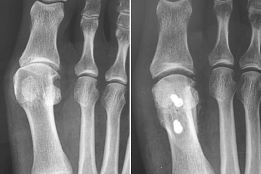 Ostéotomie du premier métatarsien selon Weil dans la prise en charge de l’hallux rigidus de stade 1 à 3 : cohorte rétrospective de 113 cas au recul moyen de 4 ans