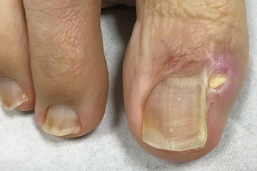 Les récidives d’ongles incarnés