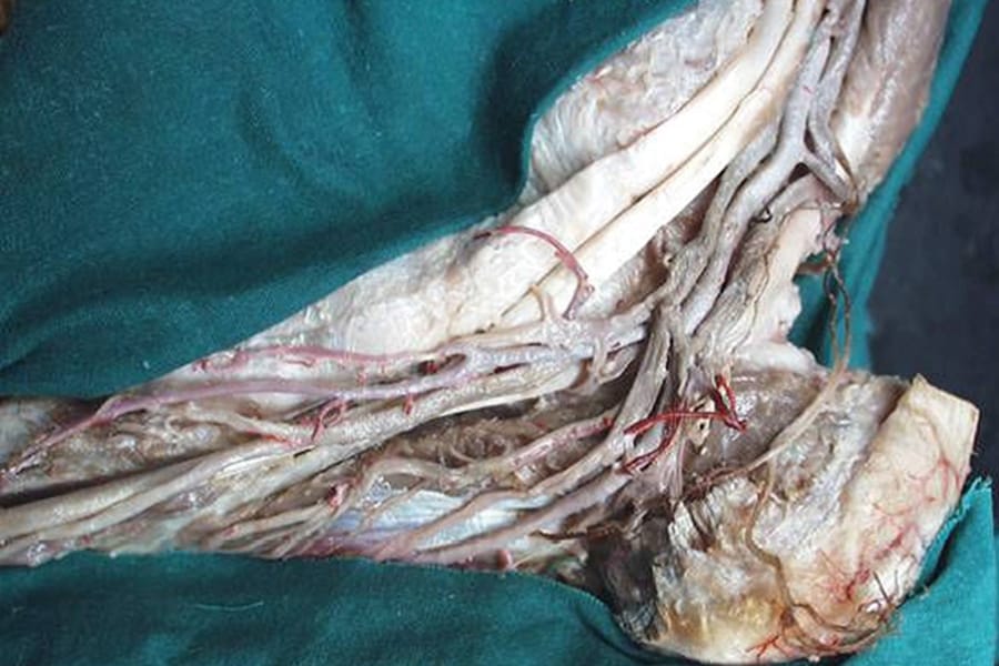 Fracture-luxation de cheville irréductible : les pièges de l’incarcération du tendon tibial postérieur