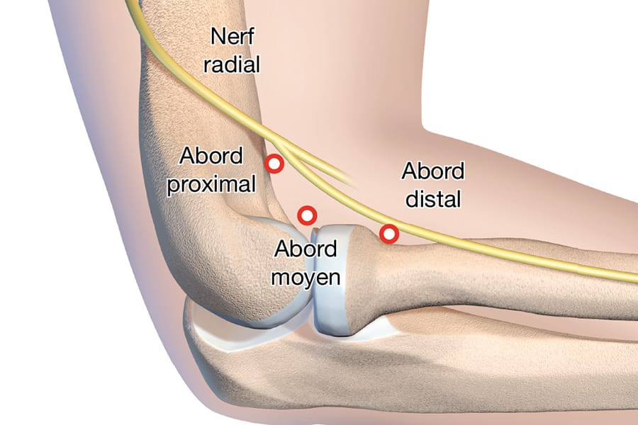 Arthrolyse arthroscopique du coude :