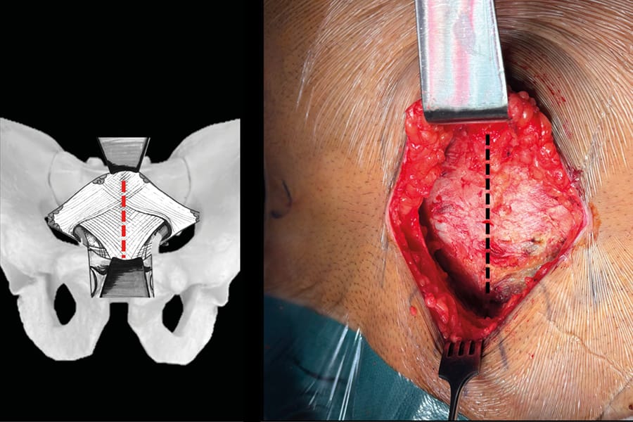 Voie antérieure intra-pelvienne (Stoppa modifiée) pour les fractures de l’acetabulum : indications et technique