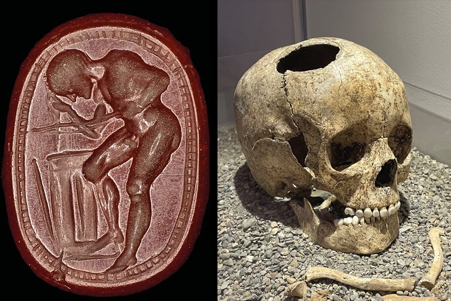 Chirurgie antique et archéologie expérimentale, une collaboration interdisciplinaire pour reproduire le passé