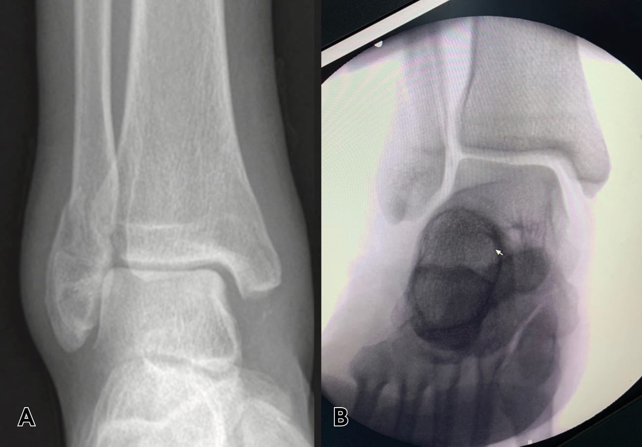 Les fractures équivalent bimalléolaire : l’abord médial
