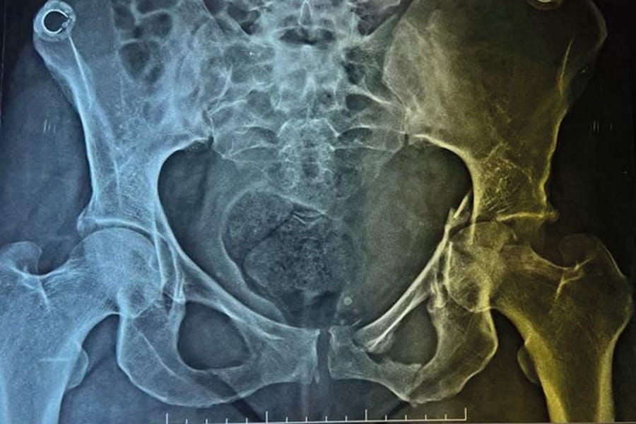 L’ostéotaxis : une nouvelle technique pour le traitement des fractures de l'acétabulum
