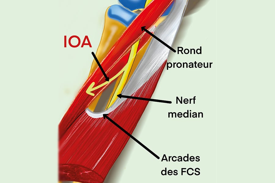 Quelle compression du nerf médian au coude ?