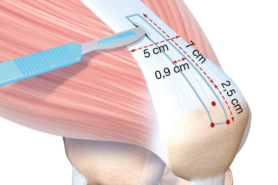 Pourquoi je choisis le tendon quadricipital pour mes reconstructions du LCA?