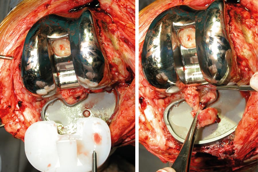 Débridement, antibiothérapie et conservation de l'implant (DAIR) dans l'infection périprothétique (IPP)