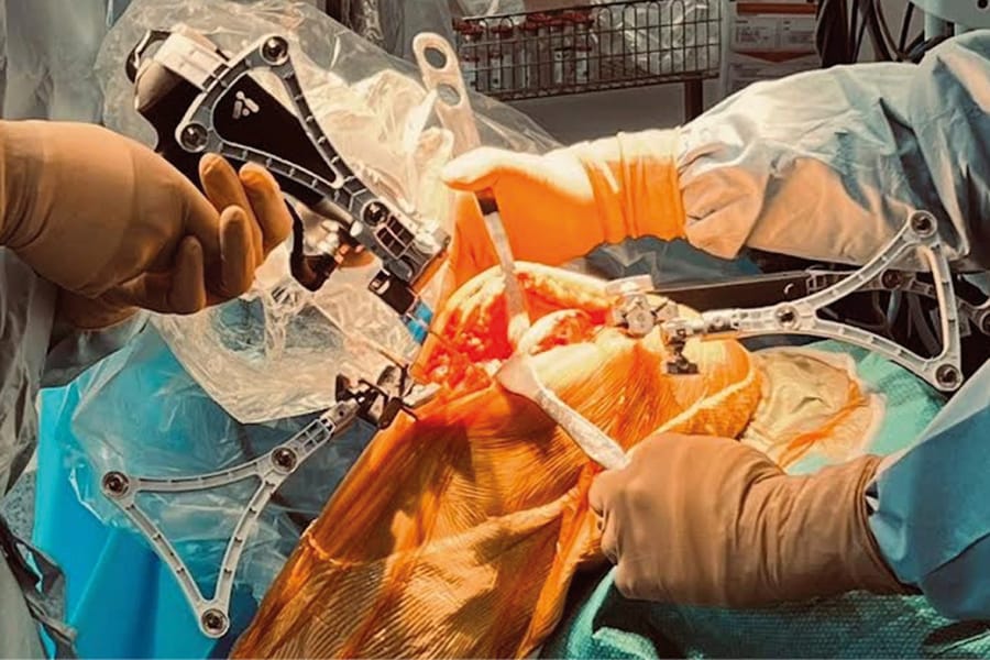 Arthroplastie unicompartimentale du genou assistée par le robot VELYS™ : indications, technique opératoire et considérations pratiques