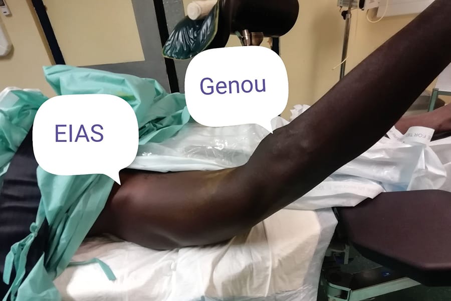 Les fractures vieillies de la diaphyse du fémur : enclouez-les toutes!