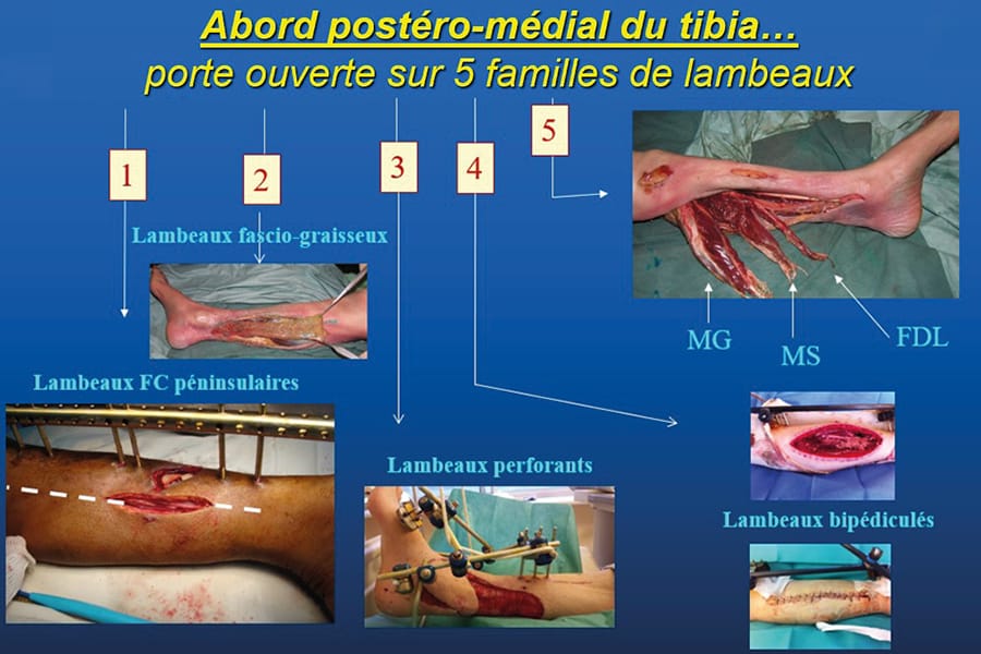 Abord postéro-médial du tibia : porte ouverte sur cinq familles de lambeaux pédiculés