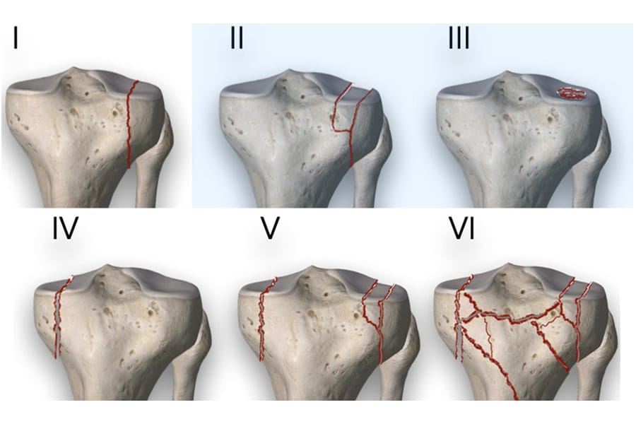 Ostéosynthèse percutanée des fractures du plateau tibial Schatzker II et III