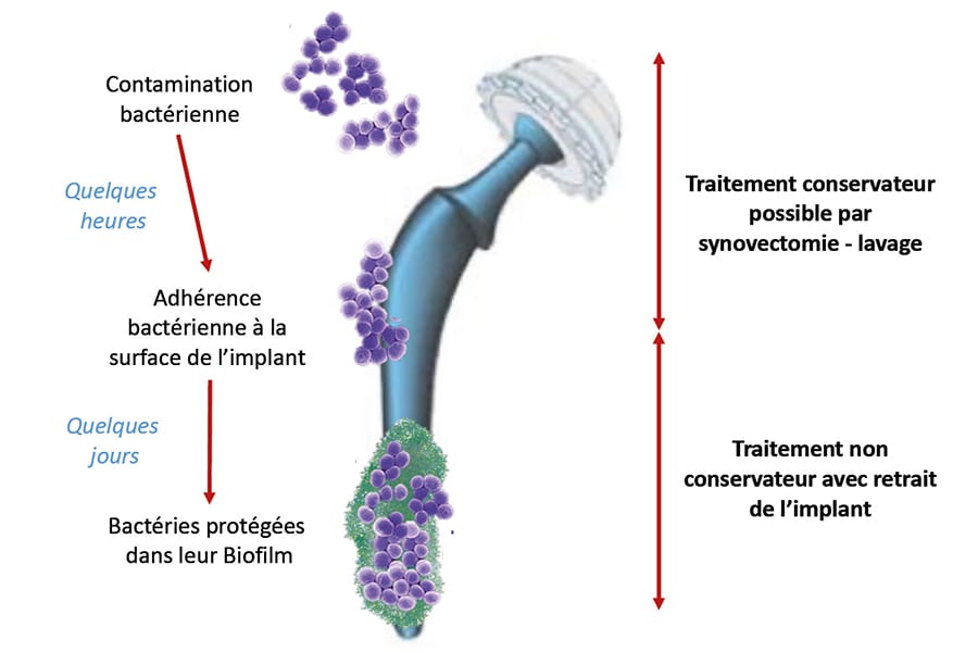 Changement de prothèse de hanche infectée en 1 temps : principes et résultats