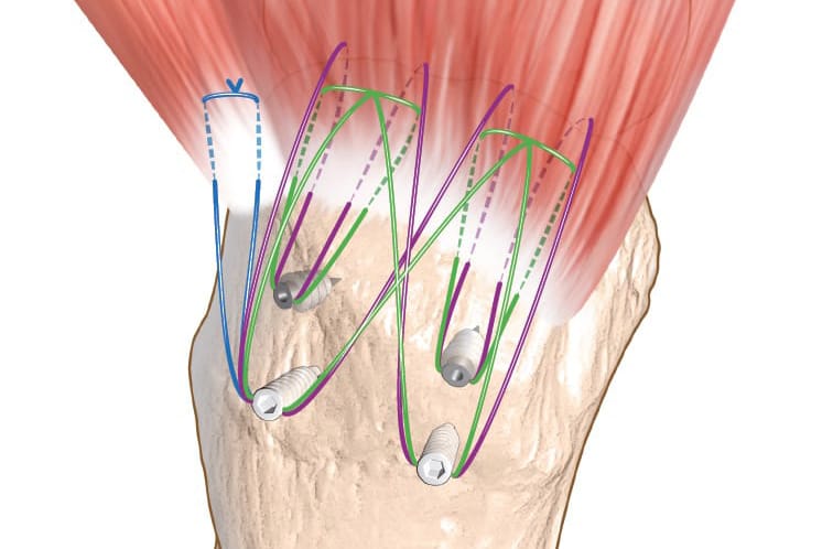 Tendinite fissuraire du moyen et du petit fessier : diagnostic et réparations chirurgicales