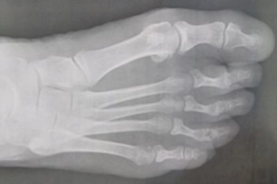 Le suivi en pratique courante de l’Hallux Valgus