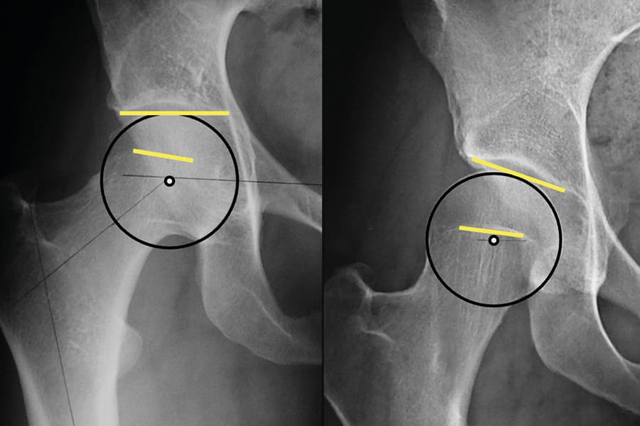 Radiographie et chirurgie conservatrice de la hanche