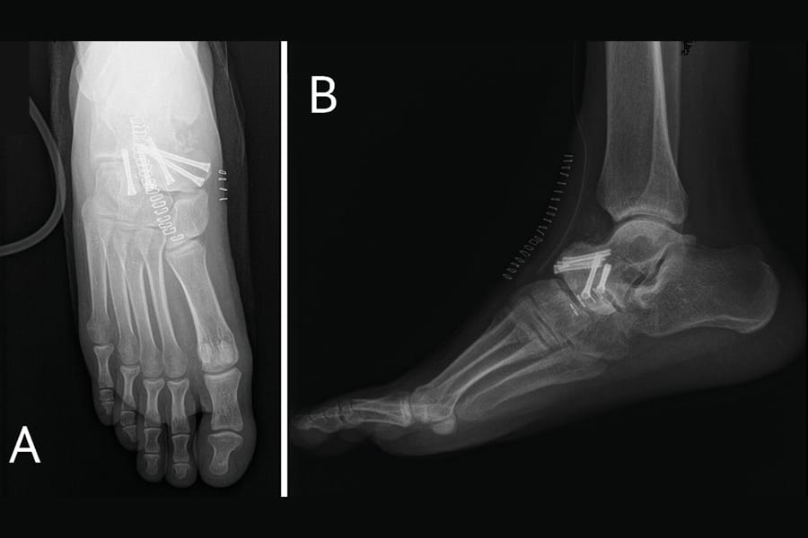 Arthrodèse isolée de la talo-naviculaire indications, technique chirurgicale et pièges