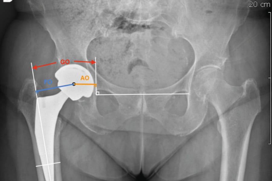 Variations de l’offset acétabulaire entre planification pré opératoire (mediCAD©) et mesure radiographique post opératoire