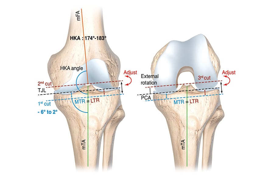 Alignement personnalisé dans la PTG : concept actuel