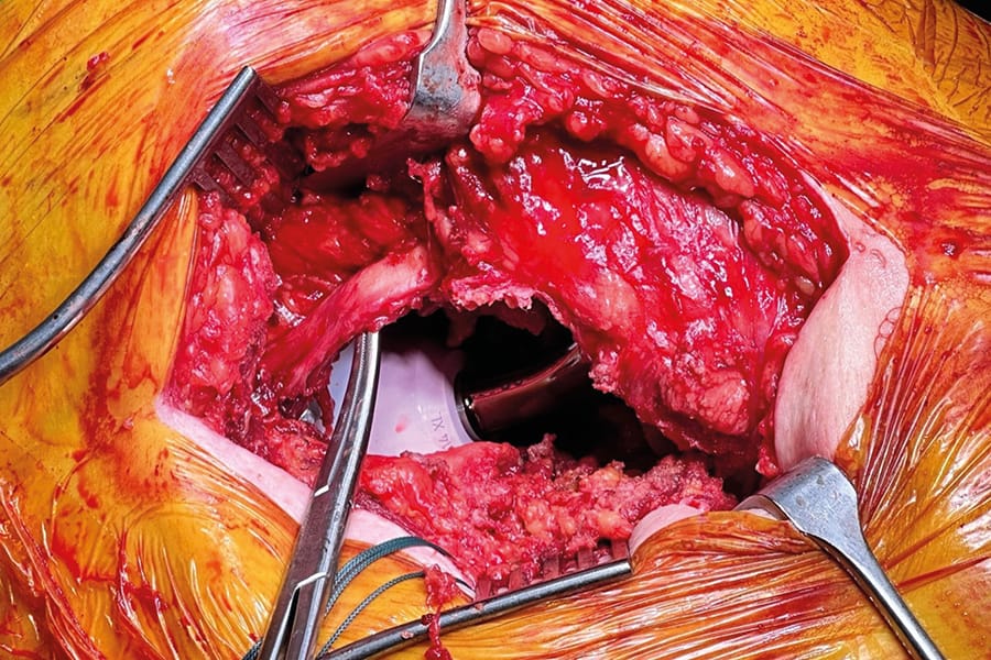 STAR : l'évolution de la voie d'abord postérieure par la conservation du piriforme