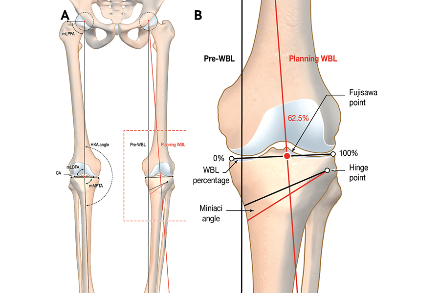 Ostéotomie fémorale distale dans la pathologie dégénérative du genou : indications, planification, techniques et complications