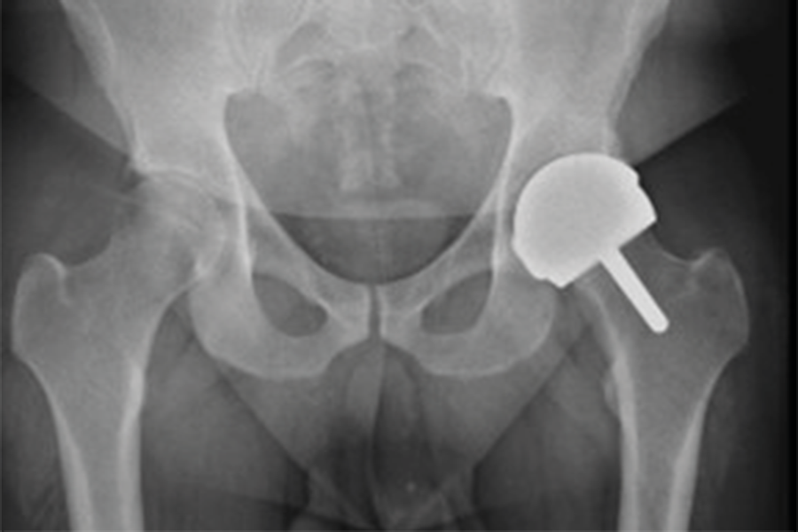 Quels facteurs influencent la reprise des activités physiques et sportives après arthroplastie de hanche chez le patient jeune ? Résultats du symposium