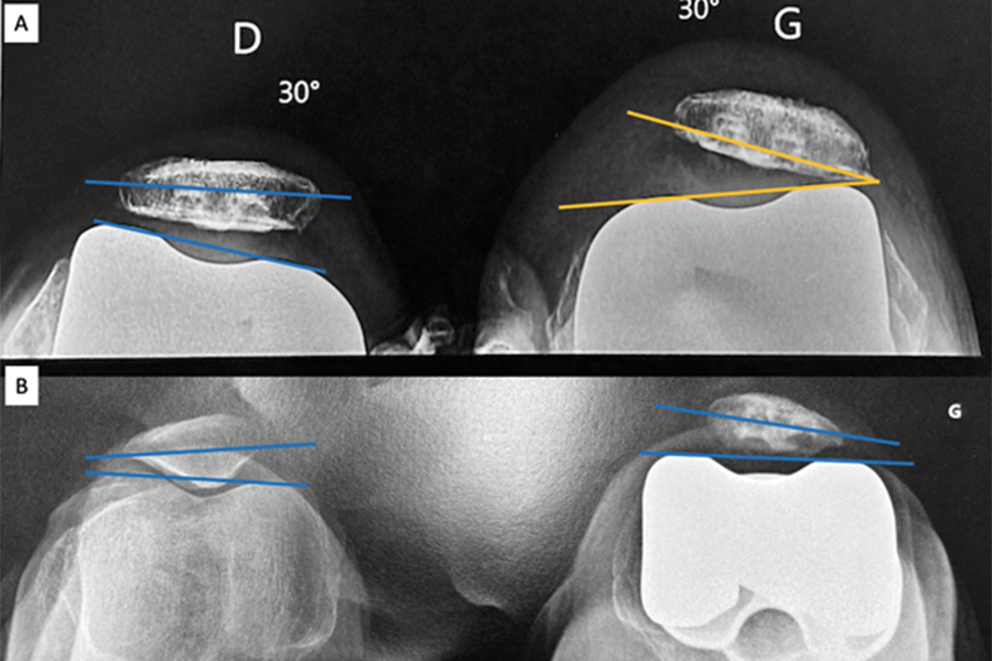 Alignement fonctionnel : quel intérêt pour la fémoro-patellaire ?