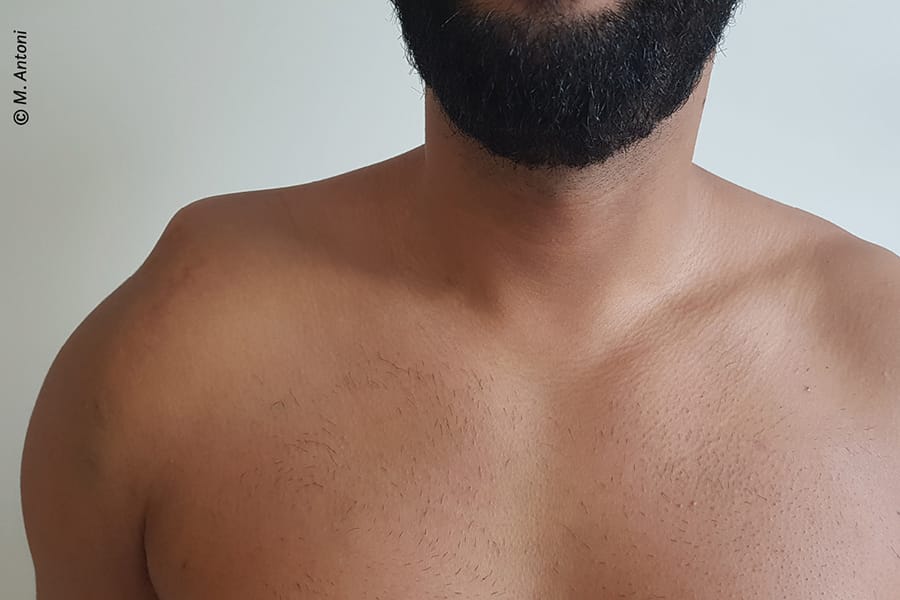 Prise en charge chirurgicale des disjonctions acromio-claviculaires chroniques