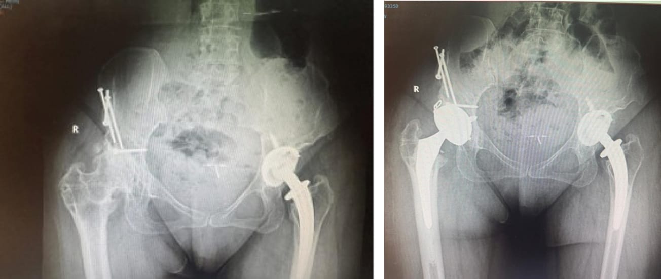 Prothèse totale de hanche après chirurgie conservatrice : pièges, difficultés et stratégies de la préservation articulaire à la reconstruction
