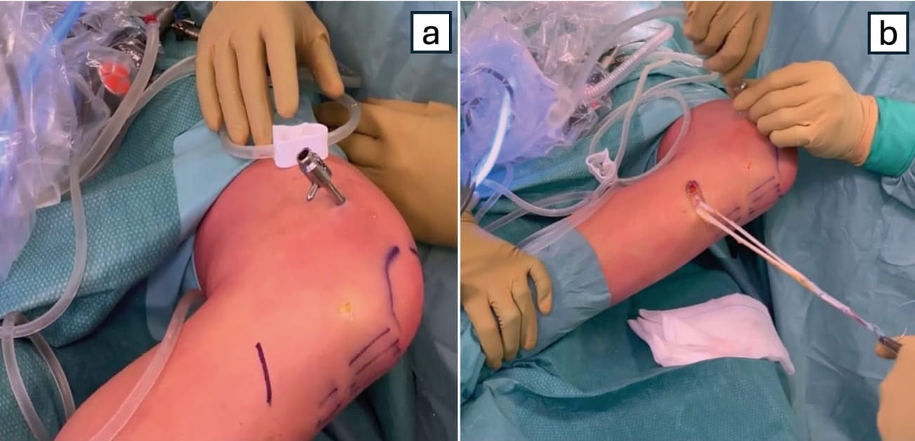 Récidives lésionnelles après reconstruction du ligament croisé antérieur et ténodèse latérale aux ischio-jambiers