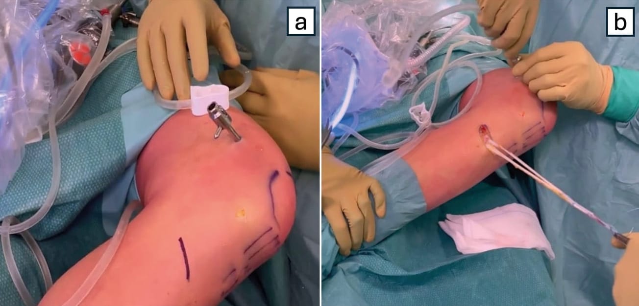 Récidives lésionnelles après reconstruction du ligament croisé antérieur et ténodèse latérale aux ischio-jambiers