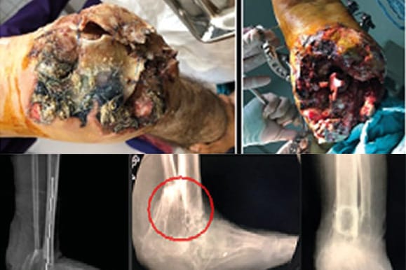 Les bactéries multirésistantes et le rôle des biofilms bactériens dans les infections musculo-squelettiques liées à la guerre