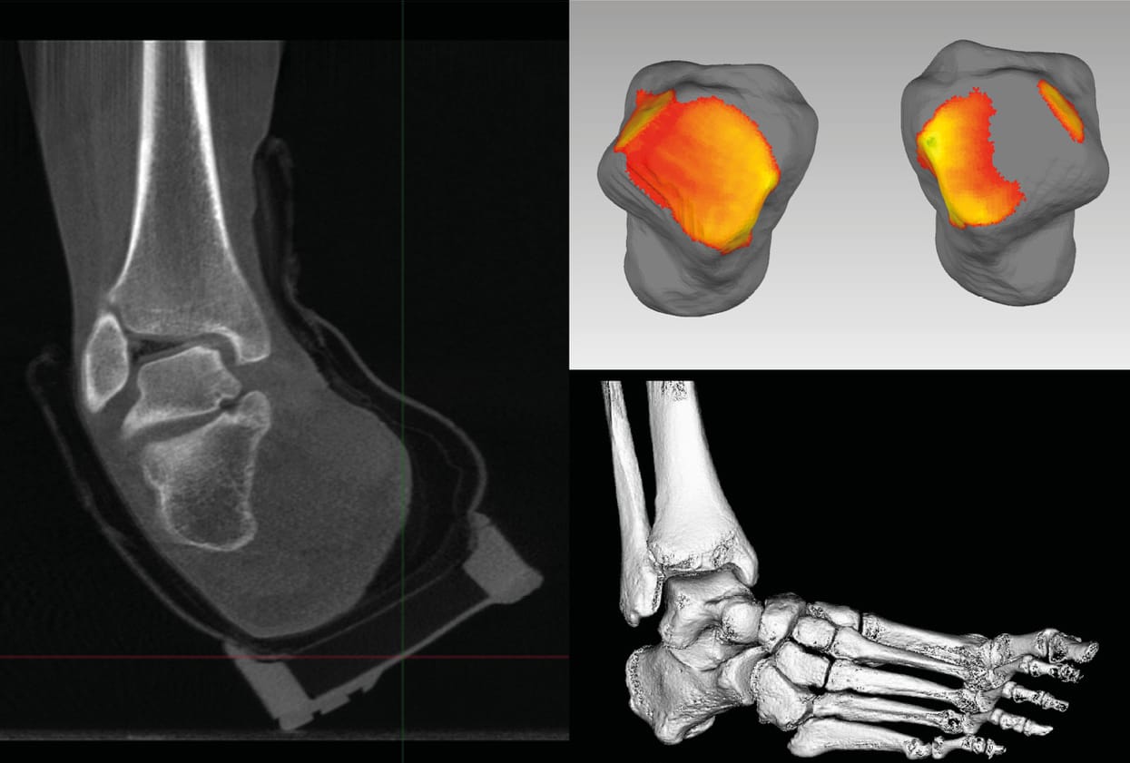 Radiographie 3D ou scanner en charge (WBCT) : un nouveau standard d'imagerie et une réorganisation du flux de travail en chirurgie du pied et de la cheville
