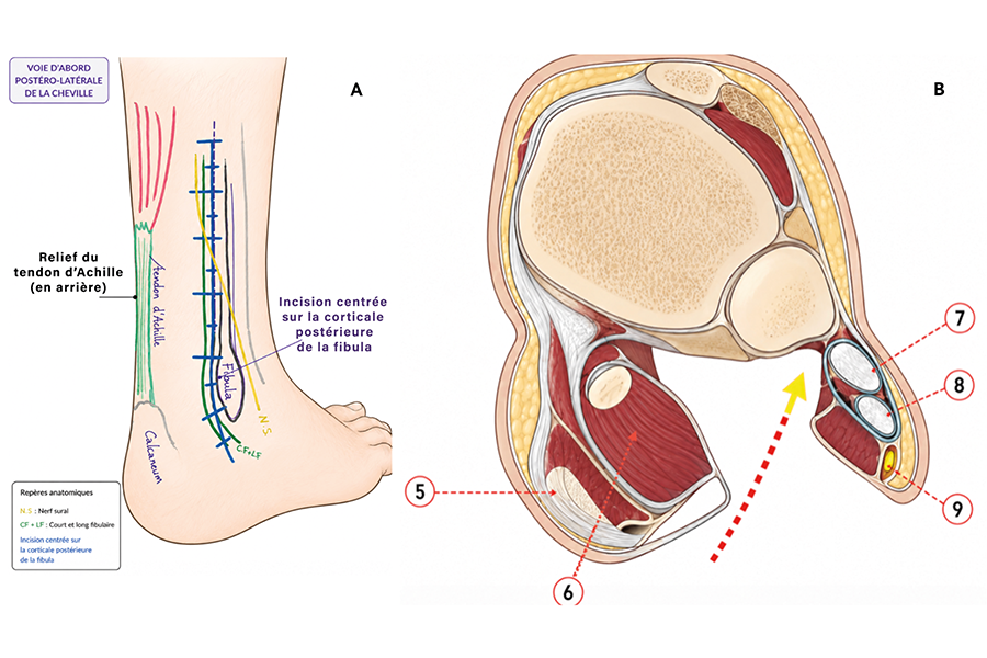 Abord(s) postérieur(s) de cheville en chirurgie traumatologique: quelle place pour le postéro-médial ?