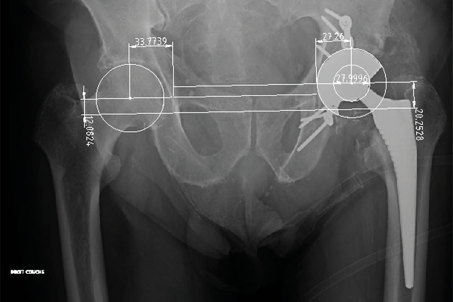 Quel est le meilleur moment pour implanter une prothèse totale de hanche après une fracture de l’acetabulum ?