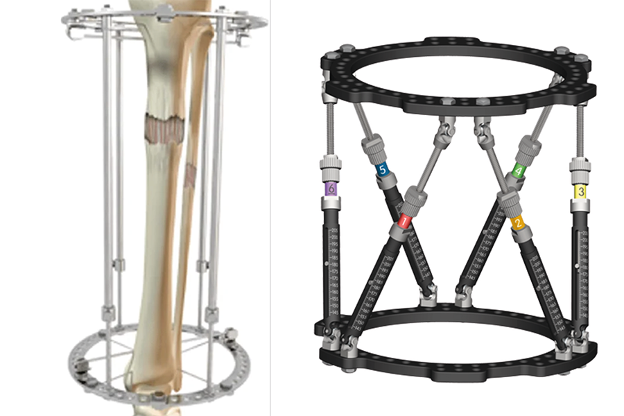 Fixateur externe circulaire dans les fractures tibiales complexes avec atteinte des parties molles : biomécanique, indications et technique