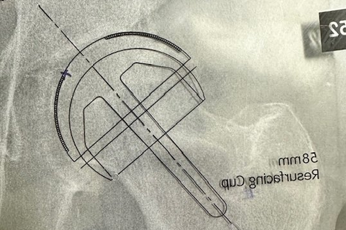 Resurfaçage de hanche par voie antérieure directe de Hueter