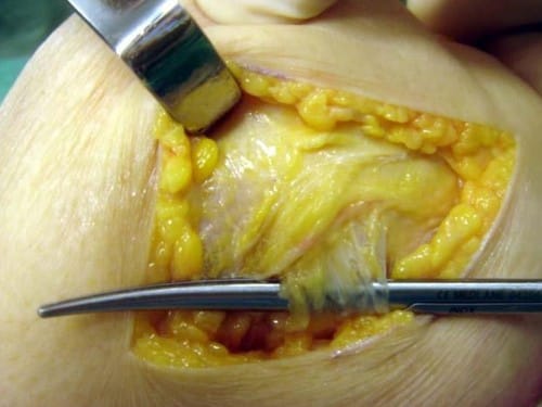 La patella : la contribution lyonnaise à la chirurgie fémoro-patellaire. 2e partie : l’ère moderne - de l’héritage de Dejour à la pratique actuelle
