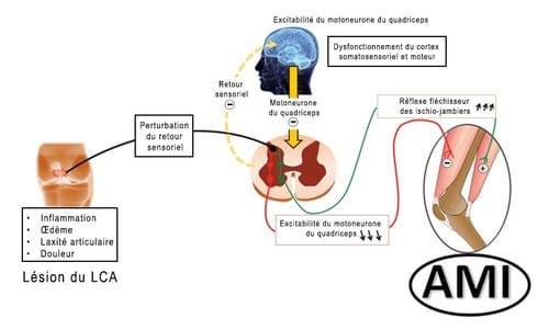 Inhibition musculaire arthrogène et arthroplastie du genou: implications pour la prise en charge rééducative