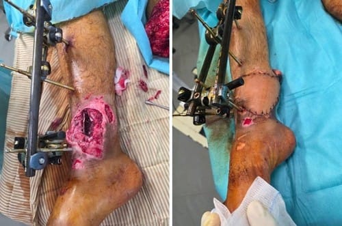 Mission de chirurgie orthopédique et plastique dans la bande de Gaza